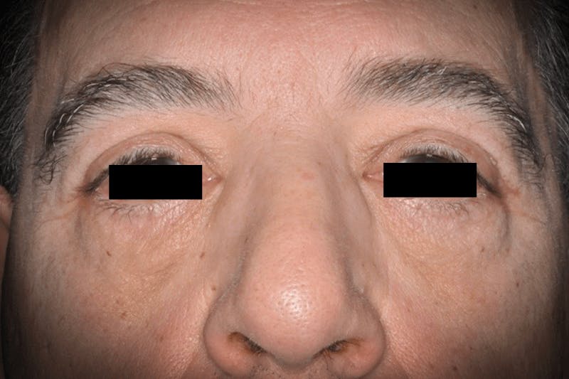 Eye Lift Before & After Gallery - Patient 171124 - Image 2