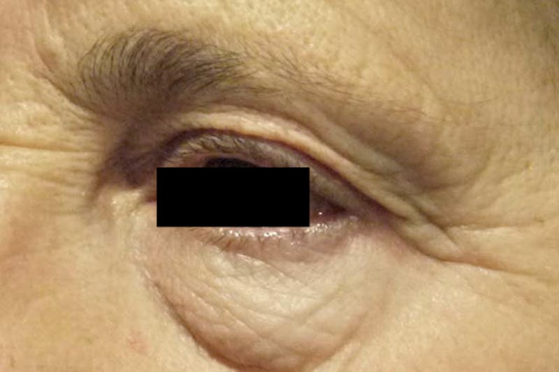 Eye Lift Before & After Gallery - Patient 422403 - Image 1