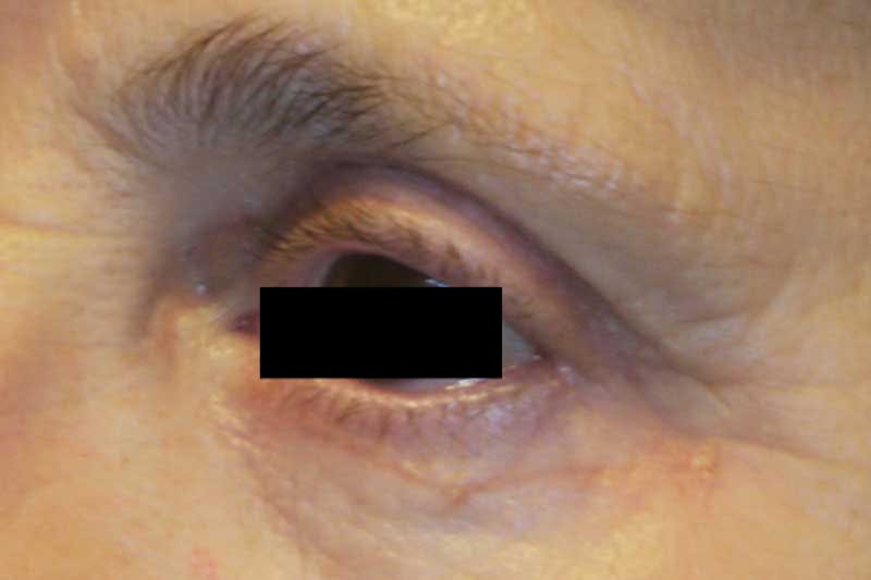 Eye Lift Before & After Gallery - Patient 422403 - Image 2