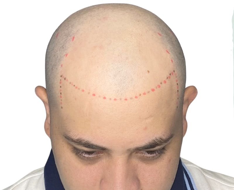Scalp Micropigmentation Before & After Gallery - Patient 120300 - Image 1