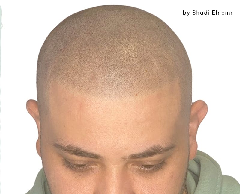 Scalp Micropigmentation Before & After Gallery - Patient 120300 - Image 2