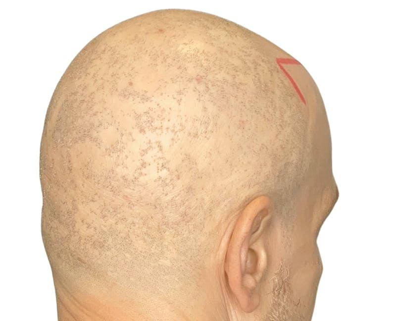 Scalp Micropigmentation Before & After Gallery - Patient 374178 - Image 1