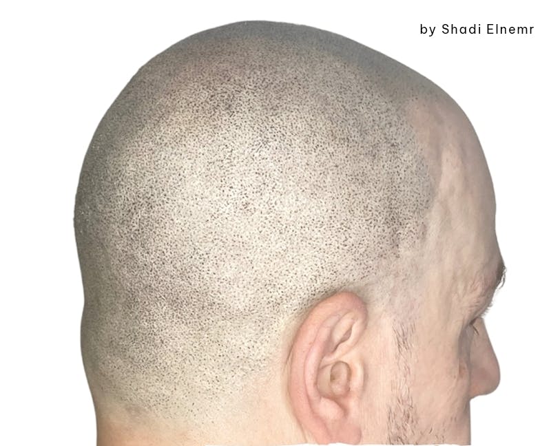 Scalp Micropigmentation Before & After Gallery - Patient 374178 - Image 2