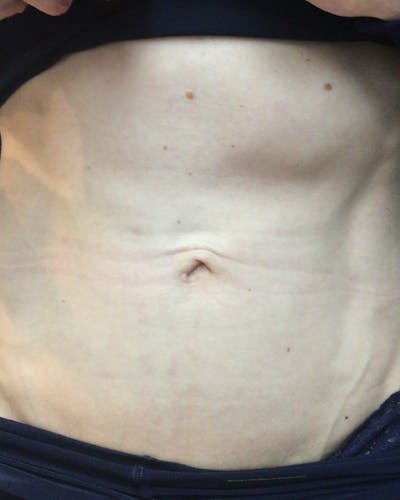 Morpheus8 Skin Tightening Before & After Gallery - Patient 225213 - Image 1