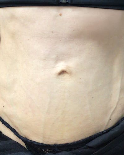 Morpheus8 Skin Tightening Before & After Gallery - Patient 225213 - Image 2