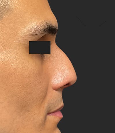 Nose Reshaping Before & After Gallery - Patient 267691 - Image 1