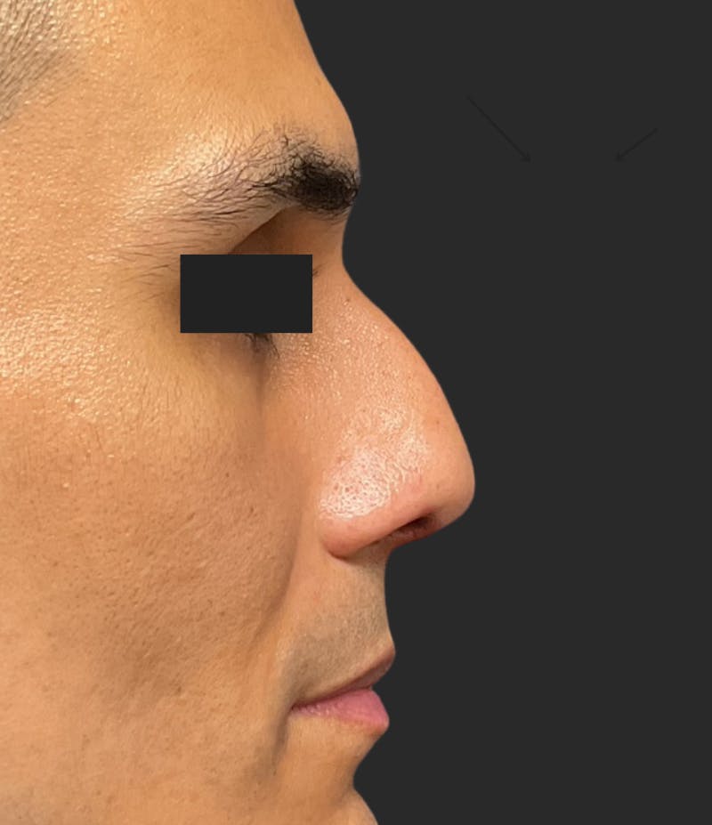 Nose Reshaping Before & After Gallery - Patient 267691 - Image 1