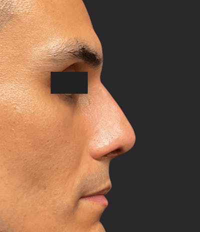 Nose Reshaping Before & After Gallery - Patient 267691 - Image 2