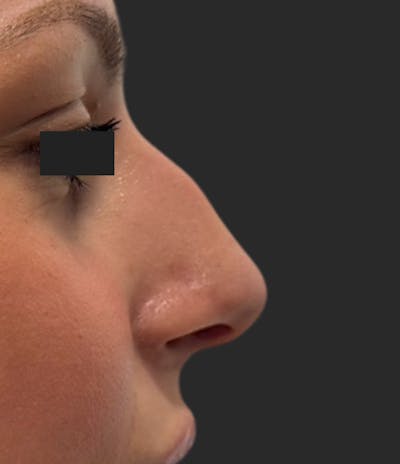 Nose Reshaping Before & After Gallery - Patient 114872 - Image 1