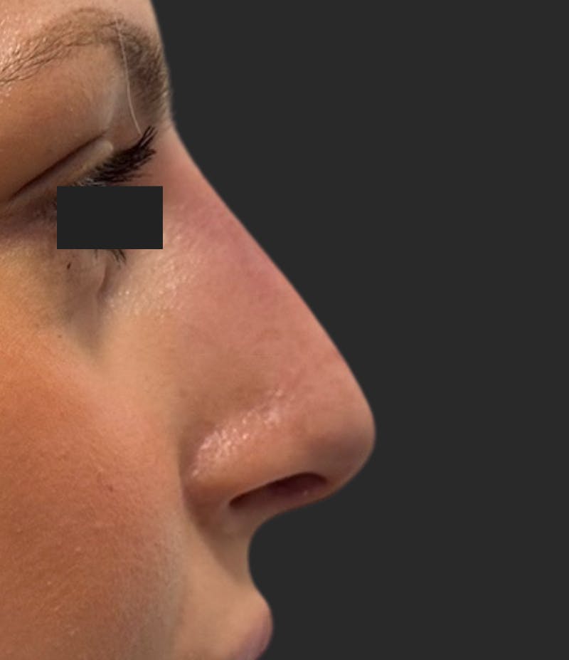 Nose Reshaping Before & After Gallery - Patient 114872 - Image 2