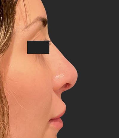 Nose Reshaping Before & After Gallery - Patient 355190 - Image 1