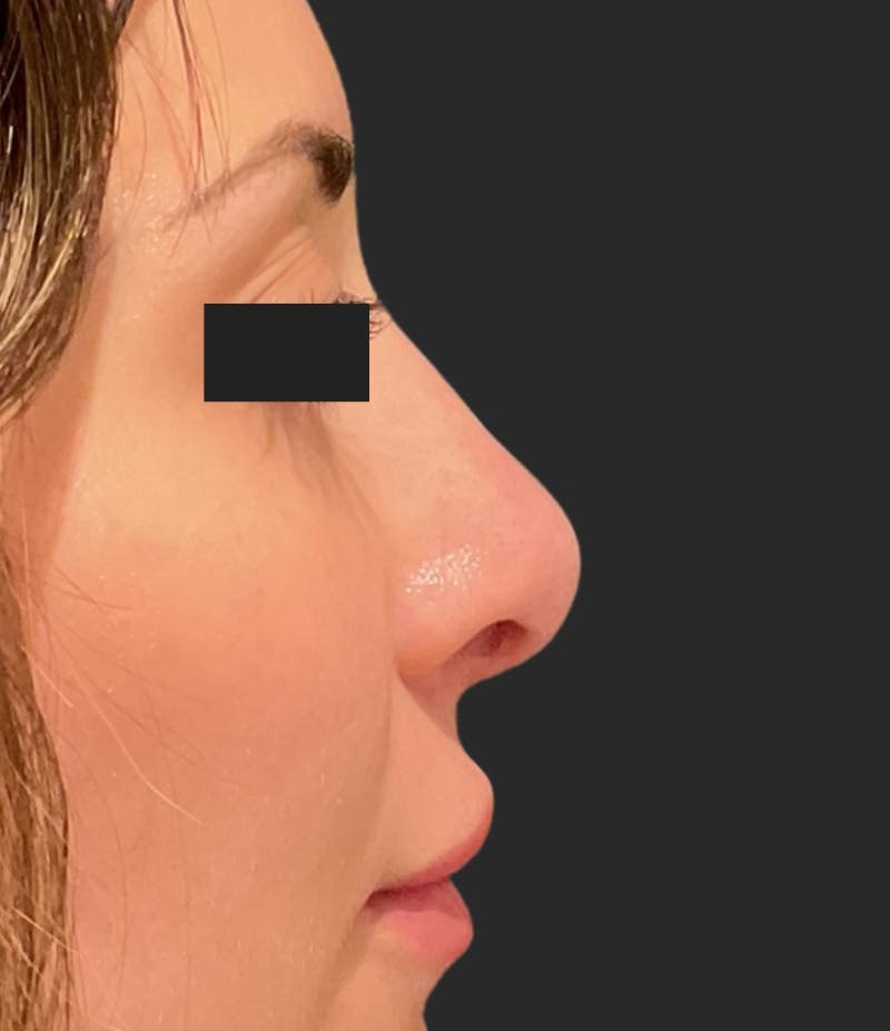 Nose Reshaping Before & After Gallery - Patient 355190 - Image 1