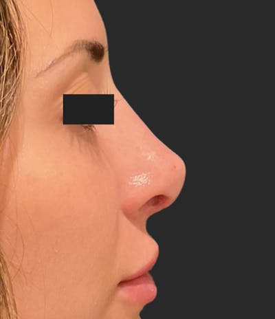 Nose Reshaping Before & After Gallery - Patient 355190 - Image 2