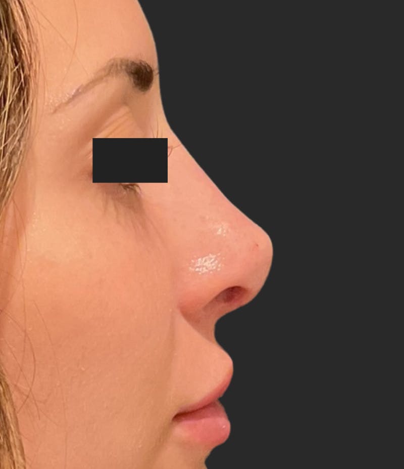 Nose Reshaping Before & After Gallery - Patient 355190 - Image 2