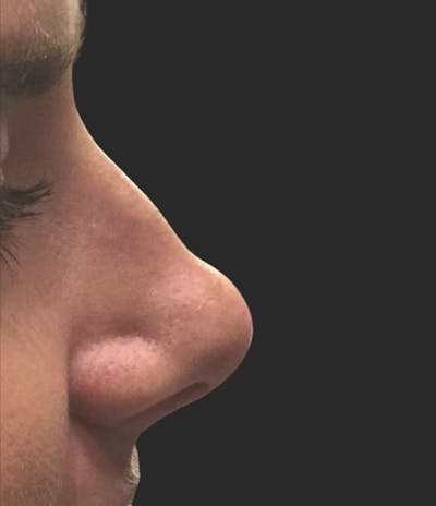 Nose Reshaping Before & After Gallery - Patient 221771 - Image 1