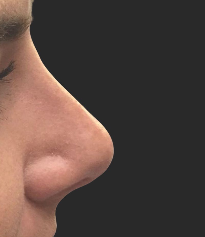 Nose Reshaping Before & After Gallery - Patient 221771 - Image 2