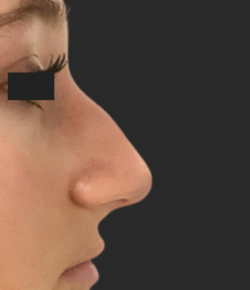 Nose Reshaping Before & After Gallery - Patient 395288 - Image 1