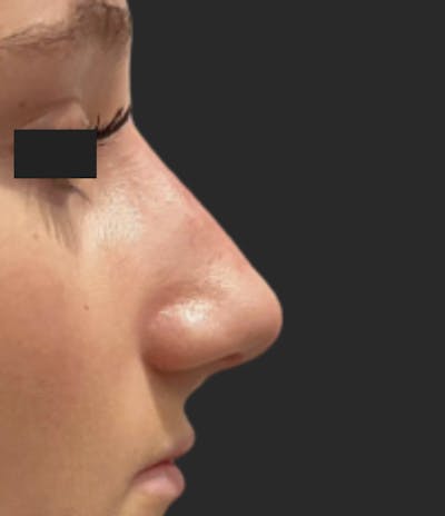Nose Reshaping Before & After Gallery - Patient 395288 - Image 2