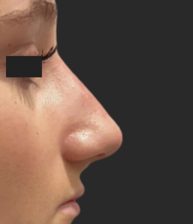 Nose Reshaping Before & After Gallery - Patient 395288 - Image 2
