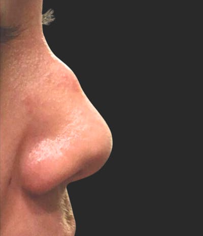 Nose Reshaping Before & After Gallery - Patient 135499 - Image 1