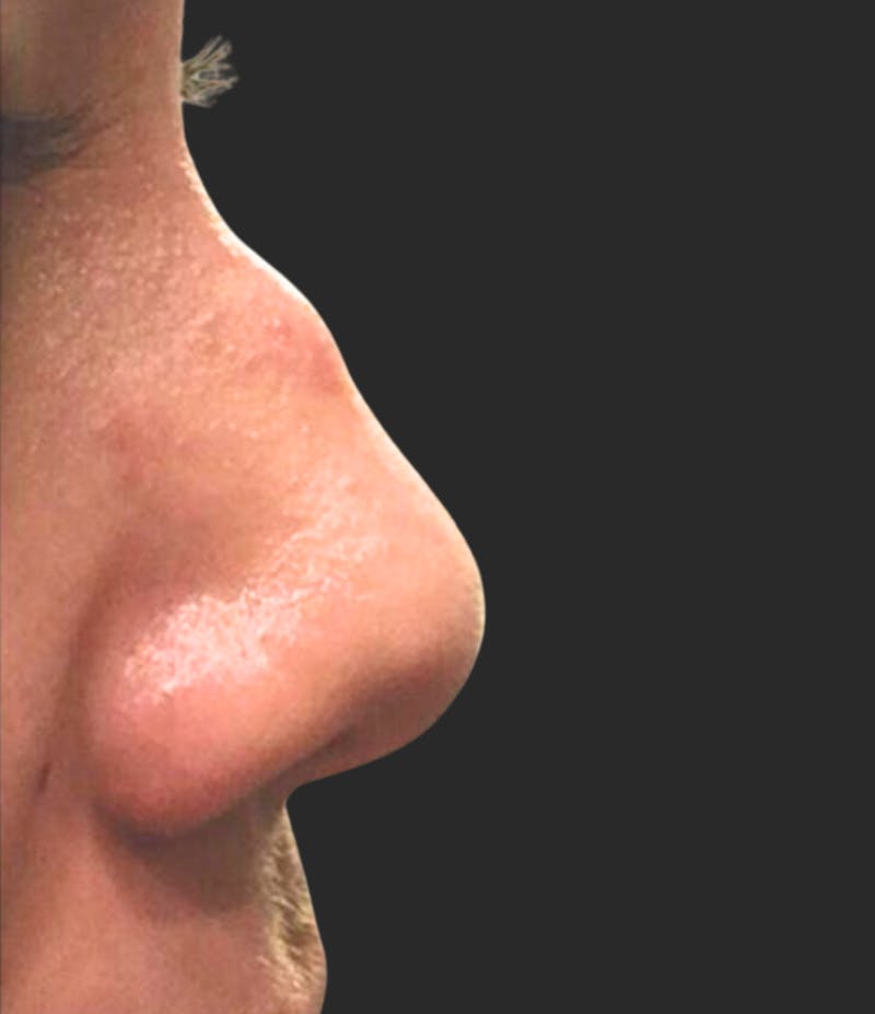 Nose Reshaping Before & After Gallery - Patient 135499 - Image 1