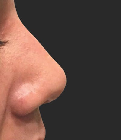 Nose Reshaping Before & After Gallery - Patient 135499 - Image 2