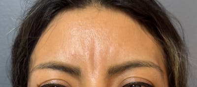 Glabellar Fillers Before & After Gallery - Patient 424305 - Image 1