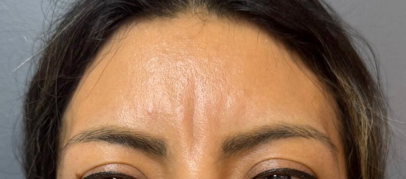 Glabellar Fillers Before & After Gallery - Patient 424305 - Image 1
