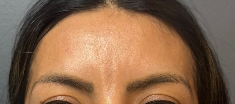 Glabellar Fillers Before & After Gallery - Patient 424305 - Image 2