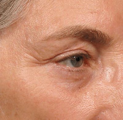 Ultherapy Skin Tightening Before & After Gallery - Patient 313708 - Image 1