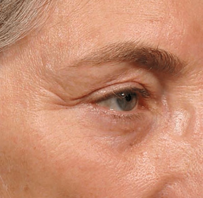 Ultherapy Skin Tightening Before & After Gallery - Patient 313708 - Image 1