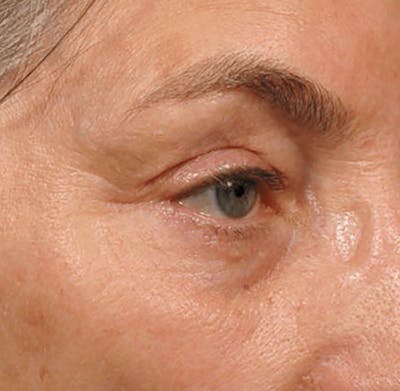 Ultherapy Skin Tightening Before & After Gallery - Patient 313708 - Image 2
