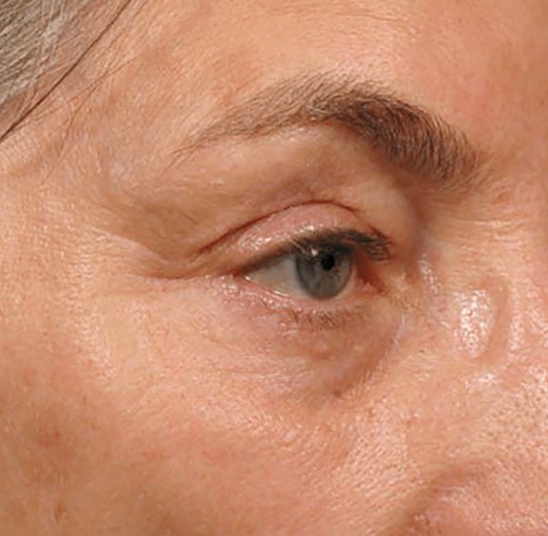 Ultherapy Skin Tightening Before & After Gallery - Patient 313708 - Image 2