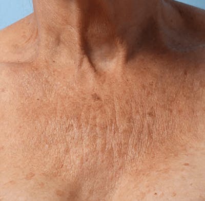 Ultherapy Skin Tightening Before & After Gallery - Patient 494841 - Image 1