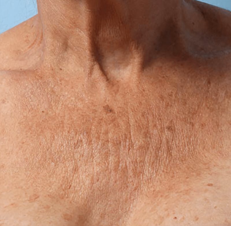 Ultherapy Skin Tightening Before & After Gallery - Patient 494841 - Image 1