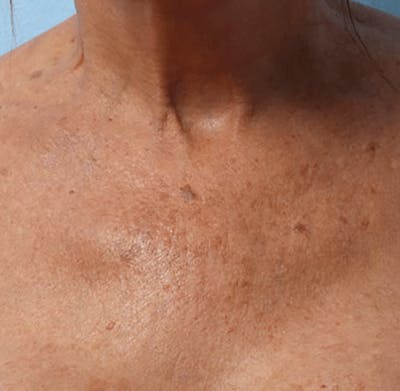 Ultherapy Skin Tightening Before & After Gallery - Patient 494841 - Image 2