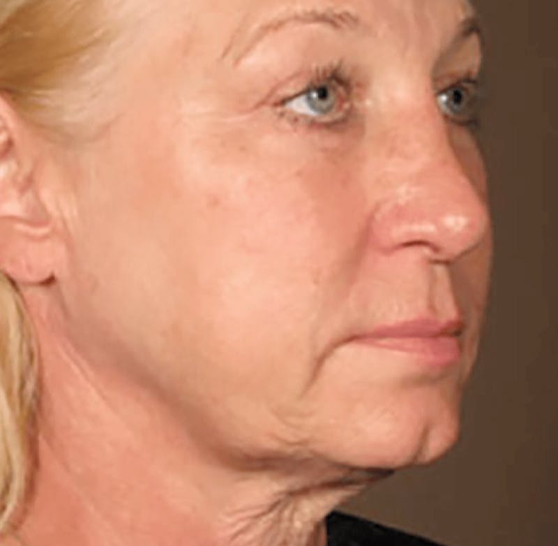 Ultherapy Skin Tightening Before & After Gallery - Patient 168665 - Image 1