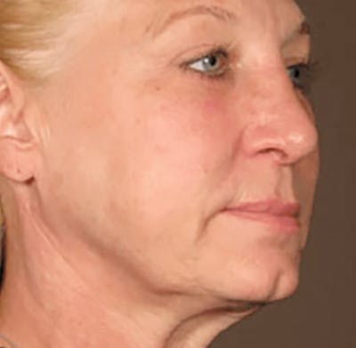 Ultherapy Skin Tightening Before & After Gallery - Patient 168665 - Image 2