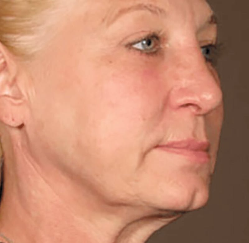 Ultherapy Skin Tightening Before & After Gallery - Patient 168665 - Image 2