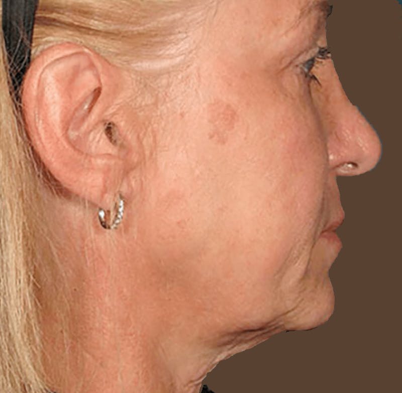 Ultherapy Skin Tightening Before & After Gallery - Patient 746934 - Image 1