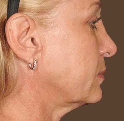 Ultherapy Skin Tightening Before & After Gallery - Patient 746934 - Image 2