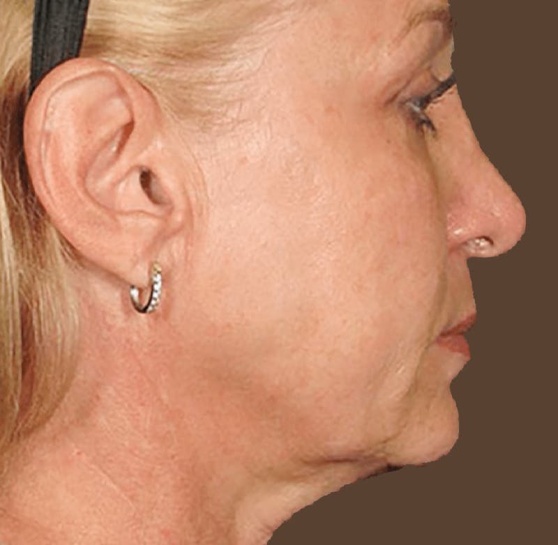 Ultherapy Skin Tightening Before & After Gallery - Patient 746934 - Image 2