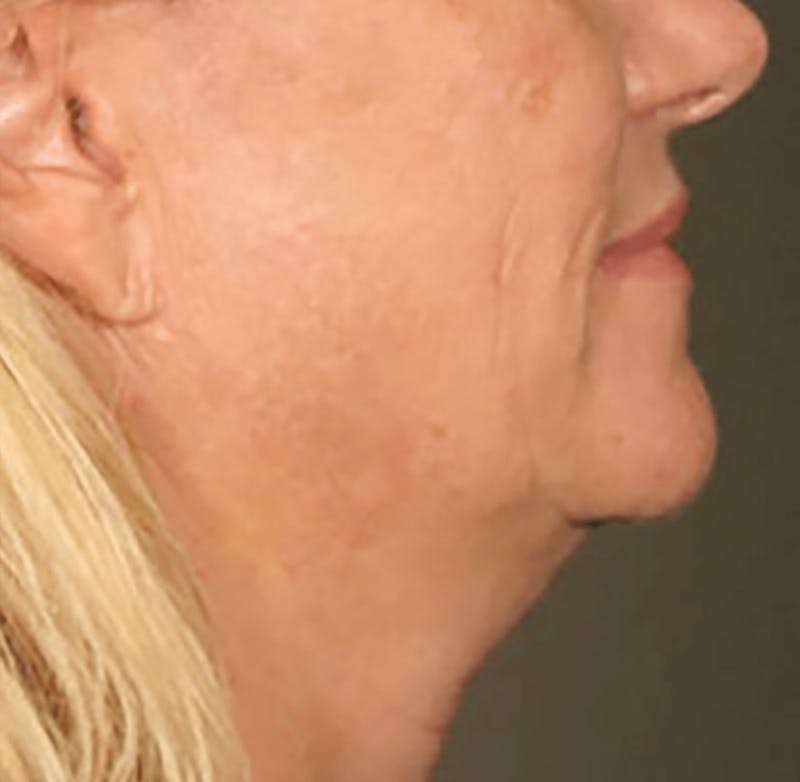 Ultherapy Skin Tightening Before & After Gallery - Patient 281164 - Image 1