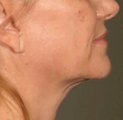 Ultherapy Skin Tightening Before & After Gallery - Patient 281164 - Image 2