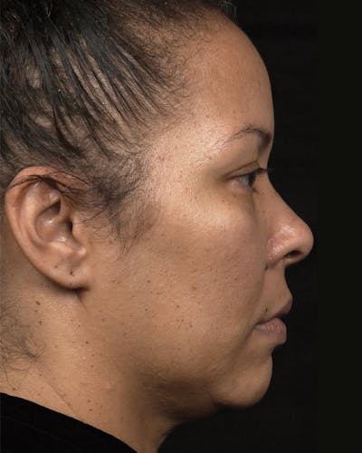 Thermage Before & After Gallery - Patient 259300 - Image 1
