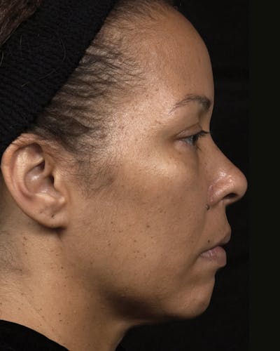 Thermage Before & After Gallery - Patient 259300 - Image 2