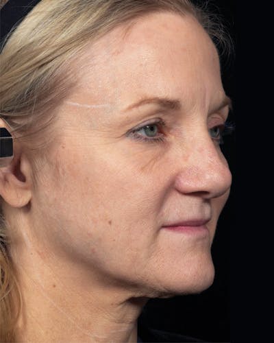 Thermage Before & After Gallery - Patient 246910 - Image 1