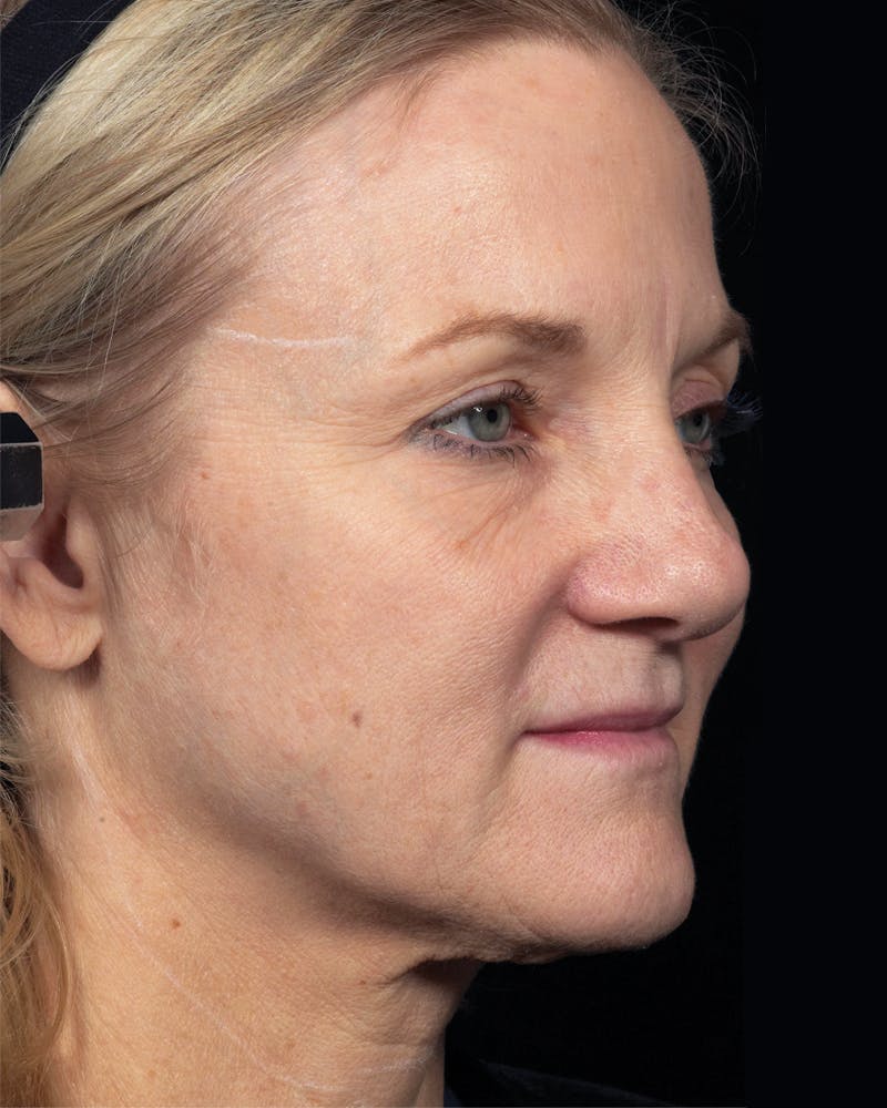 Thermage Before & After Gallery - Patient 246910 - Image 1