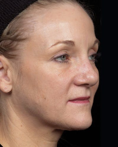 Thermage Before & After Gallery - Patient 246910 - Image 2