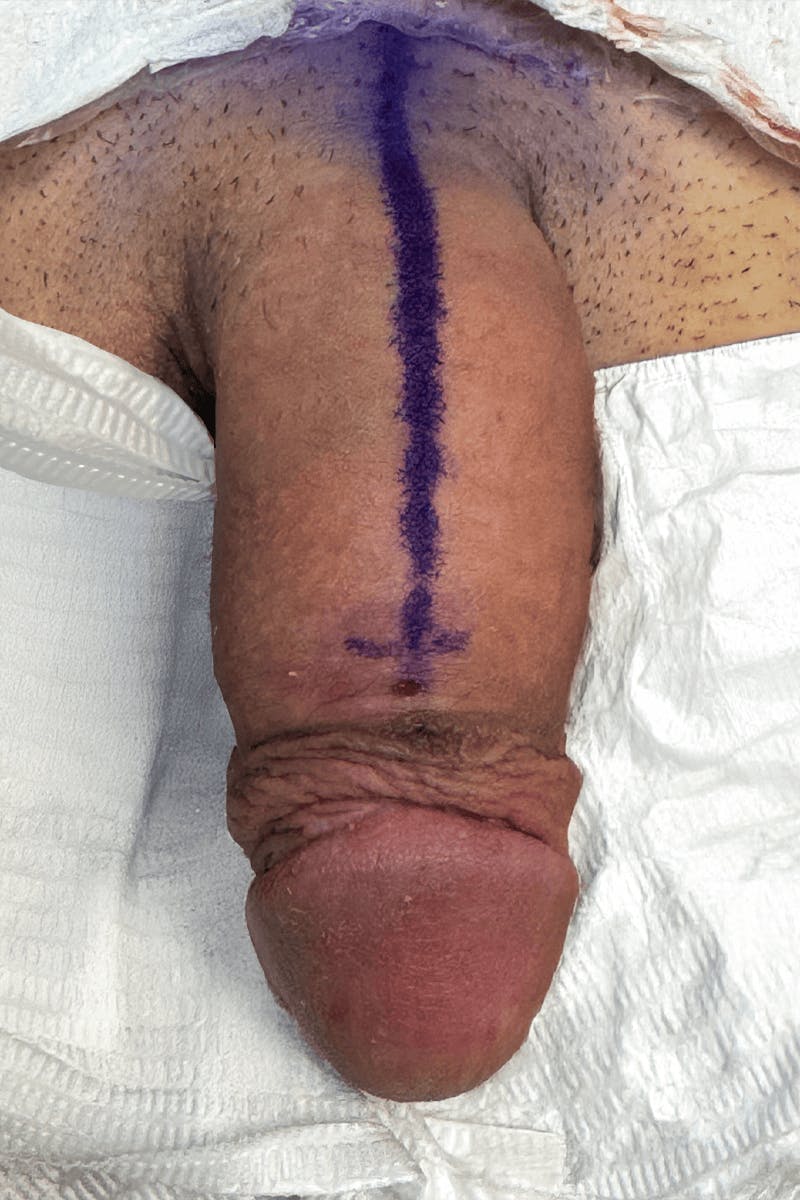 Penile Enlargement Before & After Gallery - Patient 255846 - Image 2